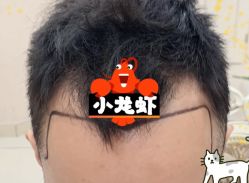 -大麦微针植发全国连锁