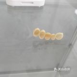 全瓷vs烤瓷