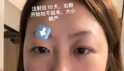 体验后-深圳艺星医疗美容医院