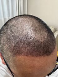 -大麦微针植发丨全国连锁