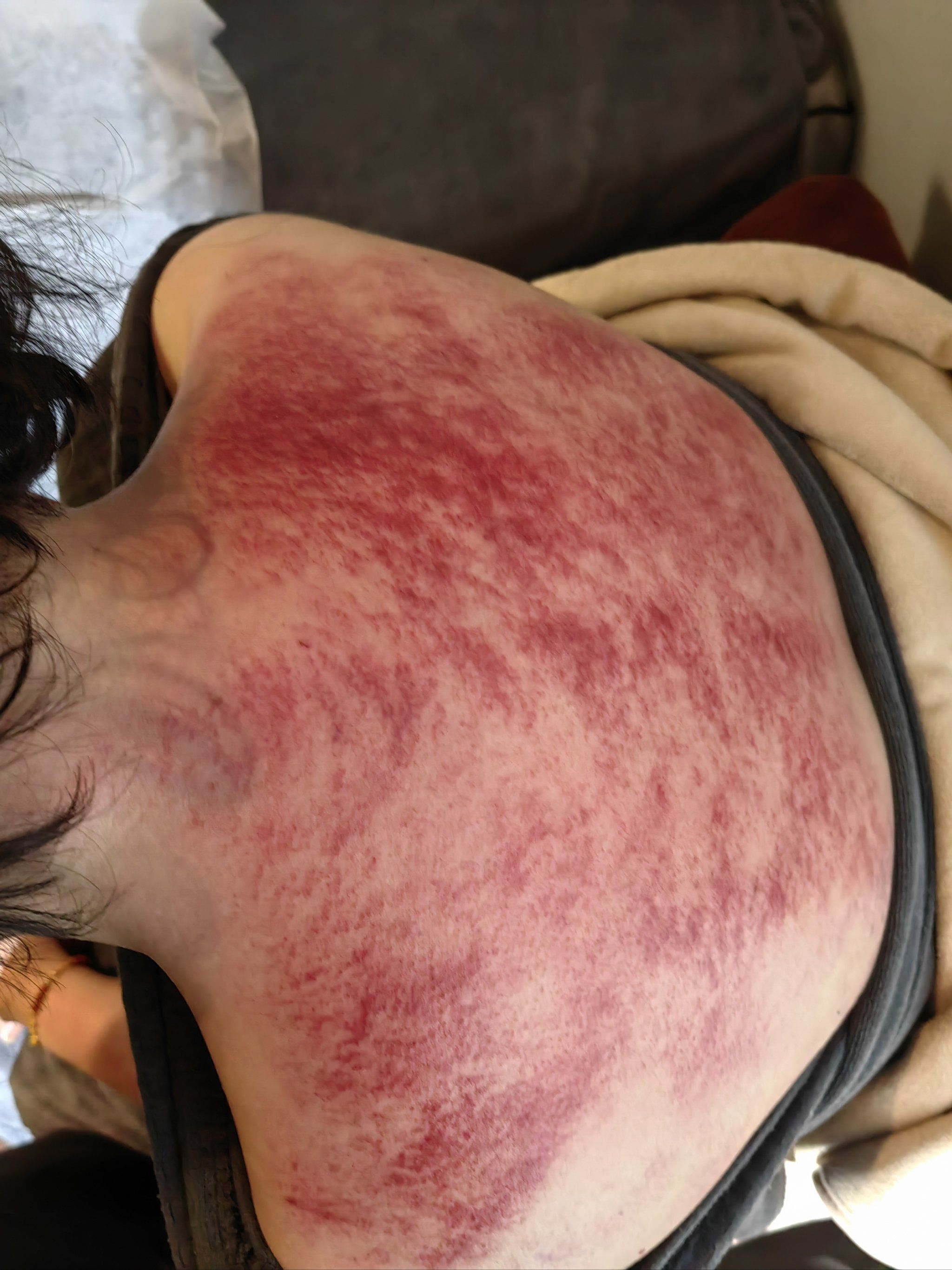 保持健康,从刮痧开始