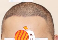 -大麦微针植发全国连锁