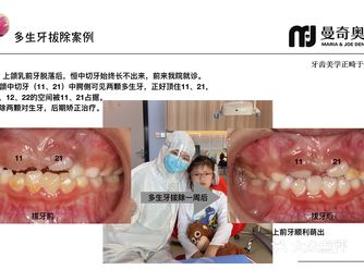 6岁的小朋友埋伏多生牙拔除案例