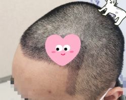 -大麦微针植发全国连锁