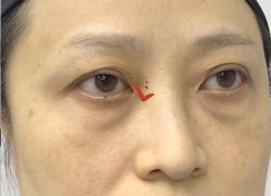 -天津健丽·去眼袋医疗美容机构