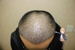 -大麦微针植发丨全国连锁