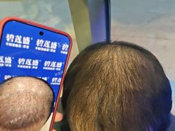 -碧莲盛·不剃发植发