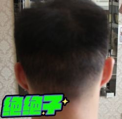 -大麦微针植发丨全国连锁