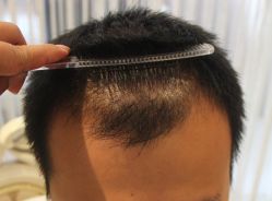 -大麦微针植发丨全国连锁