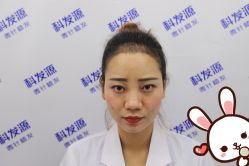 点击看大图 -大麦微针植发丨全国连锁