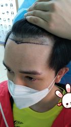 -大麦微针植发丨全国连锁