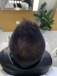 -大麦微针植发全国连锁