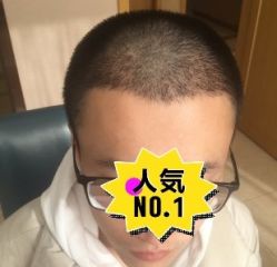 -大麦微针植发丨全国连锁