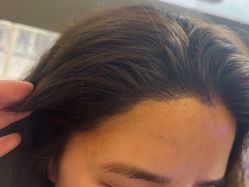 -碧莲盛·不剃发植发