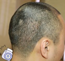 -大麦微针植发丨全国连锁