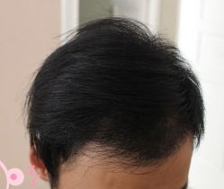 -大麦微针植发丨全国连锁