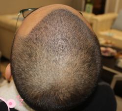 -大麦微针植发丨全国连锁