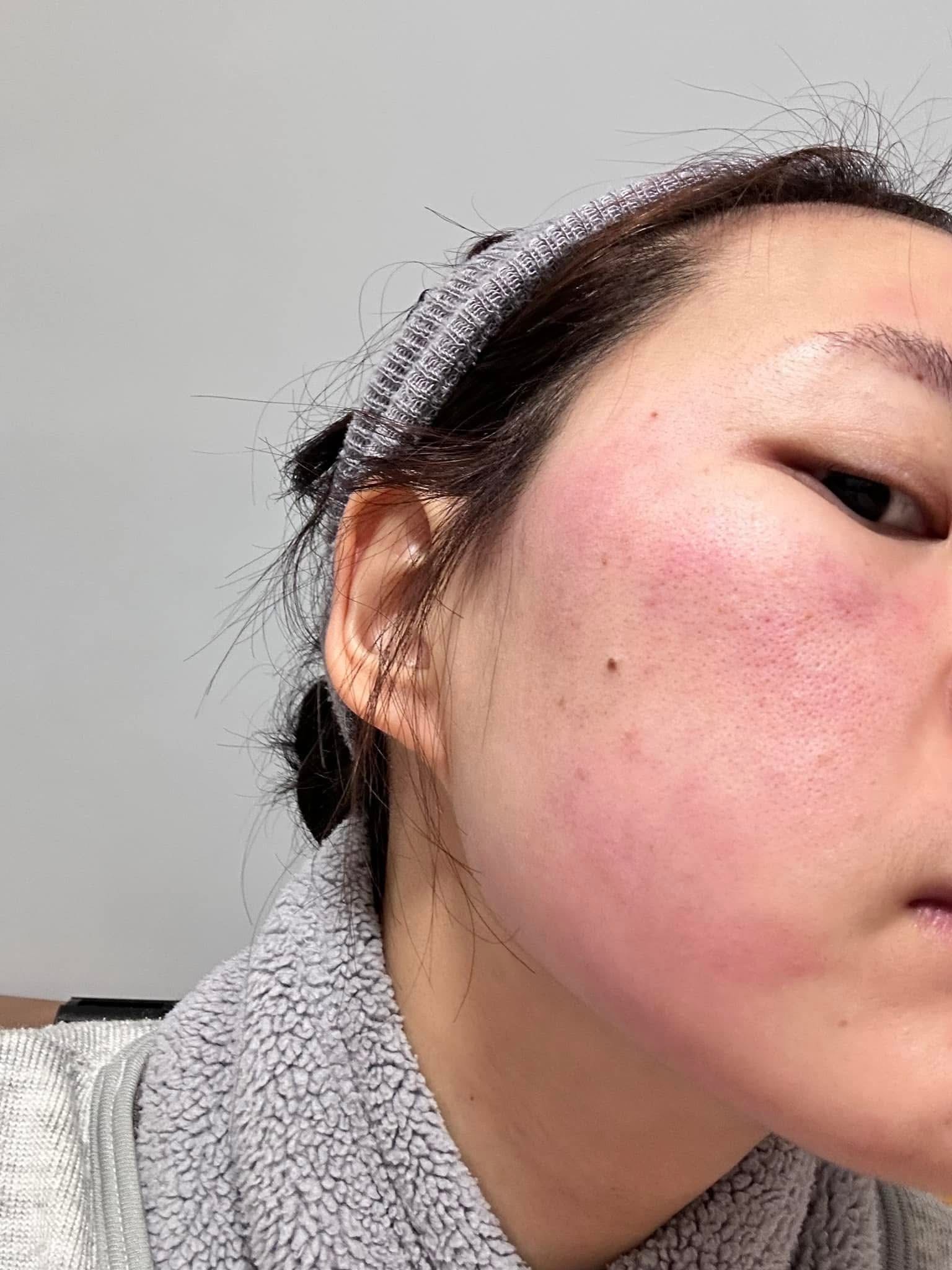 脸部过敏怎么办,有负离子面罩来帮助