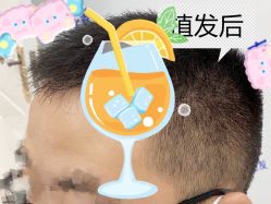 -大麦微针植发全国连锁