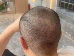 -碧莲盛·不剃发植发