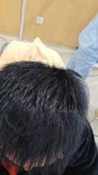 -大麦微针植发丨全国连锁