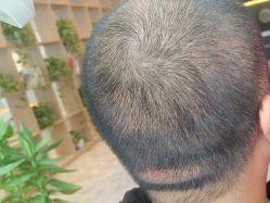 -碧莲盛·不剃发植发