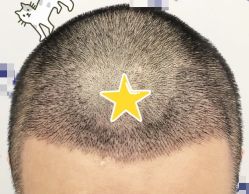 -大麦微针植发全国连锁