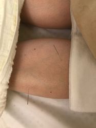 -肥三针腧穴瘦身馆