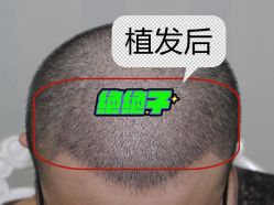 -大麦微针植发全国连锁