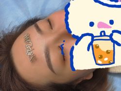 体验后-郡艺医疗美容·微整·眼鼻吸脂