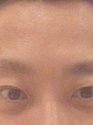 -广州健丽·去眼袋医疗美容机构