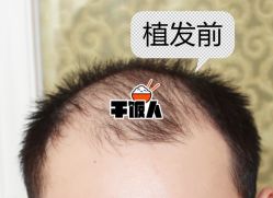 -大麦微针植发全国连锁