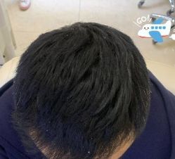 -大麦微针植发丨全国连锁