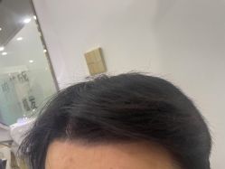 -碧莲盛·不剃发植发