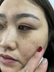 -百年美肤堂祛痦痣祛斑祛疣