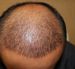 -大麦微针植发丨全国连锁