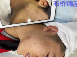 点击看大图 -痘瑞仕·专业祛痘国际连锁