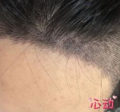 -大麦微针植发丨全国连锁