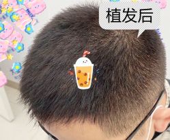 -大麦微针植发全国连锁