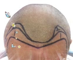 -大麦微针植发全国连锁