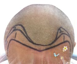 -大麦微针植发全国连锁