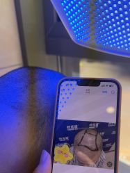 -碧莲盛·不剃发植发