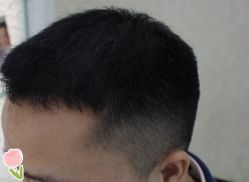 -大麦微针植发丨全国连锁