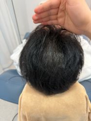 -大麦微针植发丨全国连锁