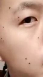 -美人痣全国连锁