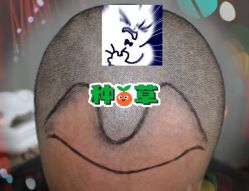 -大麦微针植发全国连锁