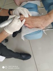 -派恩宜灰指甲鸡眼嵌甲手足癣