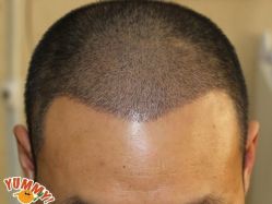 -大麦微针植发丨全国连锁