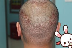 点击看大图 -大麦微针植发丨全国连锁