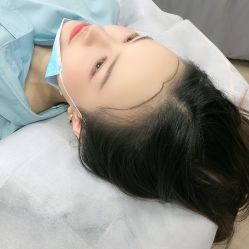 点击看大图 -西施无菌半永久纹绣眉眼影唇轻增发纹发际线